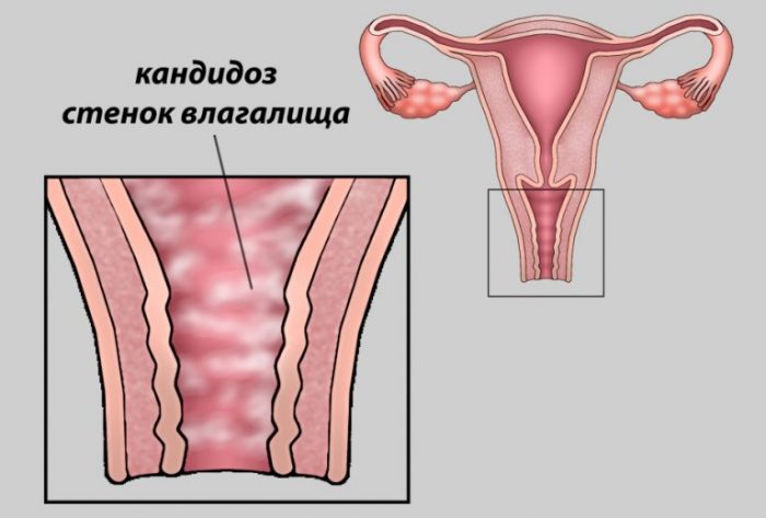 лечение вагинального кандидоза