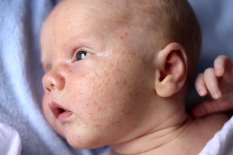 Аллергия у детей на животе фото