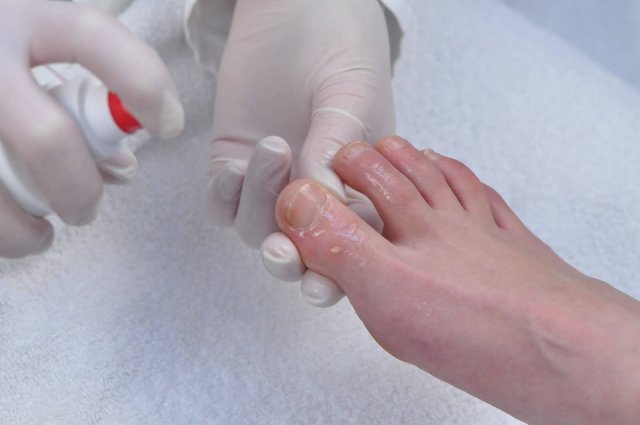 Болит ноготь на большом пальце ноги к какому врачу обратиться thumbnail