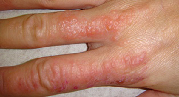 Аллергия на руках покраснение пузырьки thumbnail