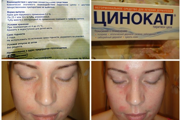 лечение дерматита на лице