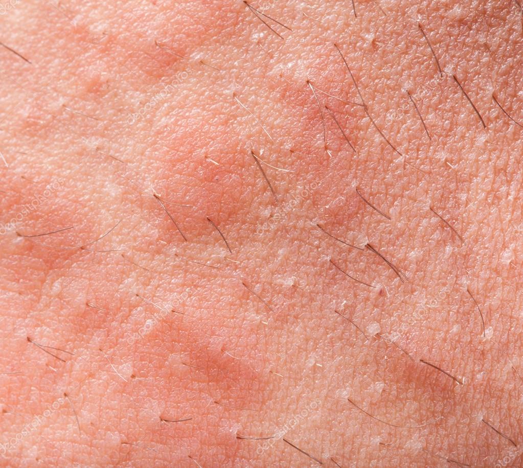 Атопический дерматит у взрослых лечение мази и кремы название фото