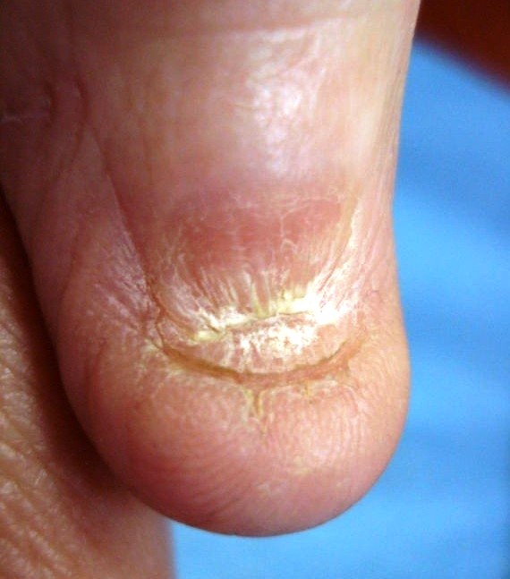 Какие кожные заболевания бывают на ногах фото