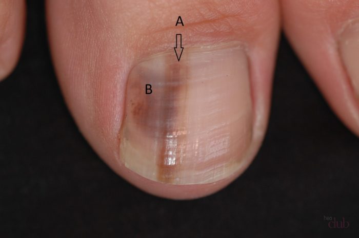 Признаки болезни по ногтям на ногах thumbnail