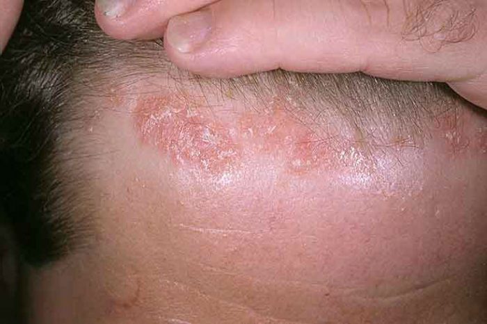  болезнь локализуется на волосистых участках головы