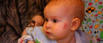 гемангиома у новорожденных