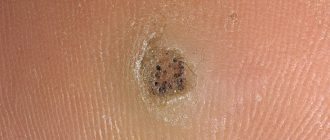 мозоли с черными точками