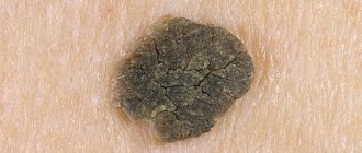 кератома образуется из верхних клеток эпидермиса