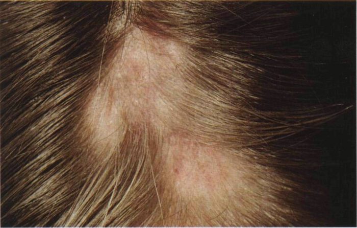 микоз на волосистой части головы