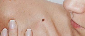 приобретенное или врожденное образование на коже