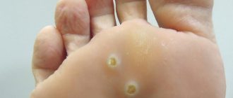 бородавки со стороны подошвы стопы
