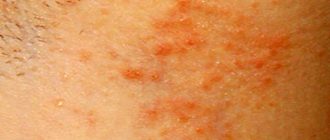 паховый грибок